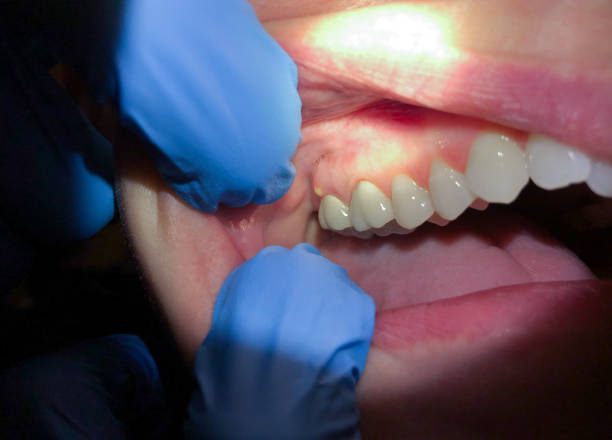 Best Emergency Wisdom Tooth Extraction in Cleveland, TX